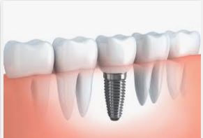 dental implants Adelaide