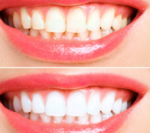 teeth whitening adelaide